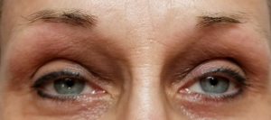 implante de pelo cejas Gijon