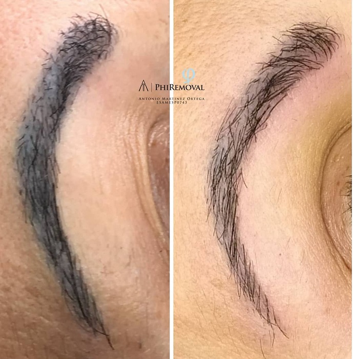 Quitar tatuaje aviles elimanar micropigmentacion