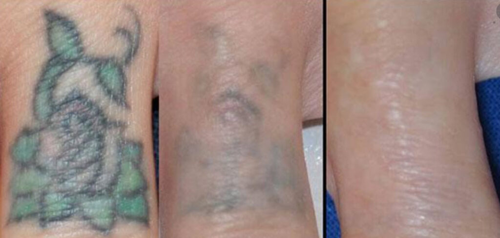 eliminacion de tatuajes aviles