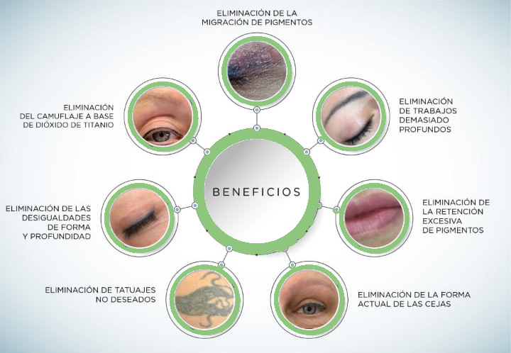 eliminacion de tatuajes como se hace